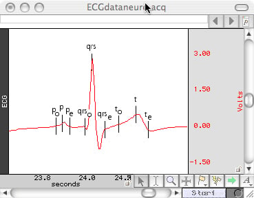 ECG100C ECG amplifier and AcqKnowledge automated ECG analysis