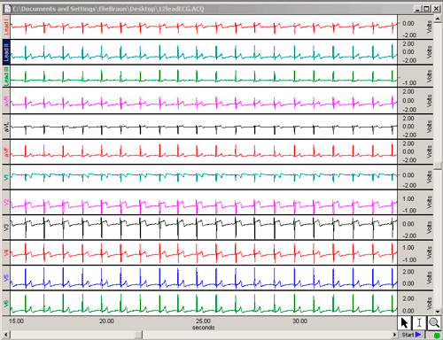 ECG 12-lead EKG