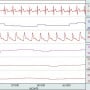 AcqKnowledge blood pressure and ECG data