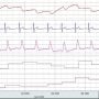 noninvasive cardiac output data in AcqKnowledge