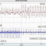 carotid to femoral pulse wave velocity (cfPWV) data