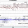 carotid to femoral pulse wave velocity data