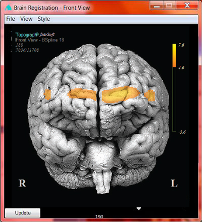 fNIR Optical Brain Imaging topograph